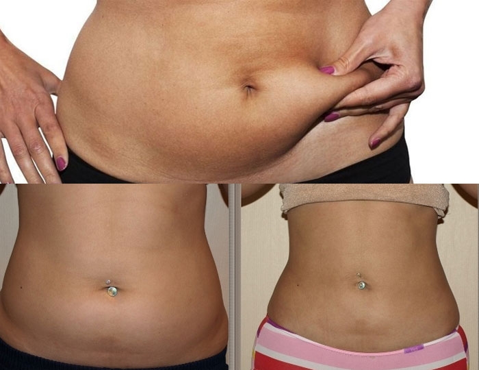 Хийжүүлсэн ундаа харвин үүсгэх гол шалтгаан болдог